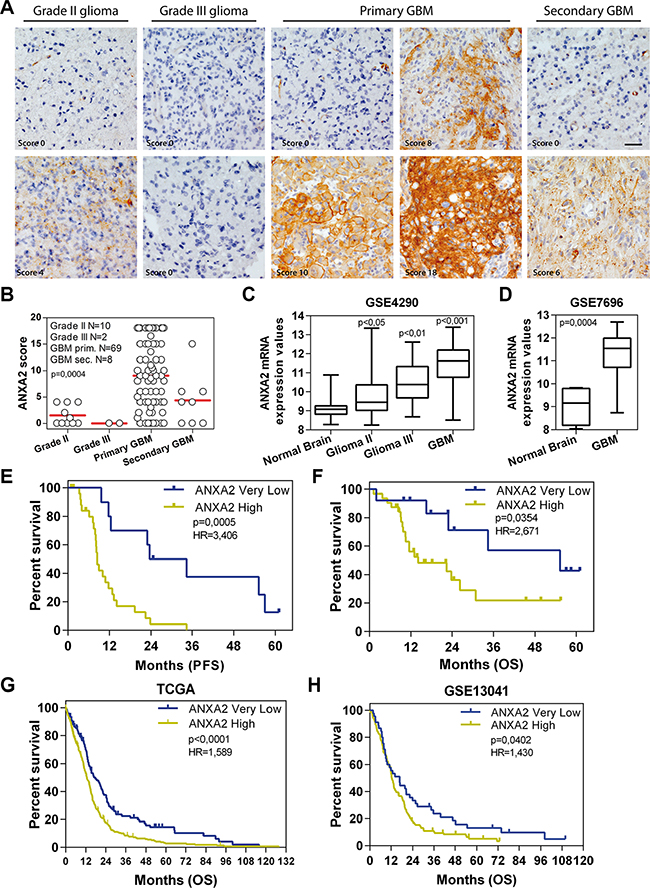 ANXA2 is over-expressed in GBM and positively correlates with bad prognosis.