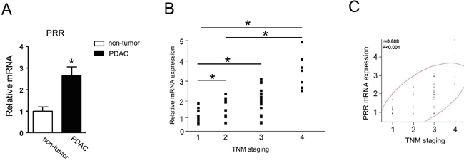 Human PRR is strongly expressed in PDAC and correlates with TNM staging.