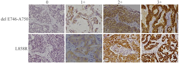 Immunohistochemical staining of human NSCLC tumor samples with antibodies specific for delE746-A750 or L858R mutant forms of EGFR.
