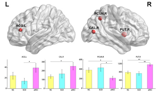 Regions with significant differences in betweenness centrality among the three groups.