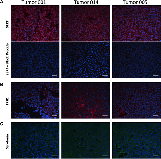 Expression of SERT, TPH1 and 5-HT in 3 independent tumors from the MMTV-Neu transgenic strain.