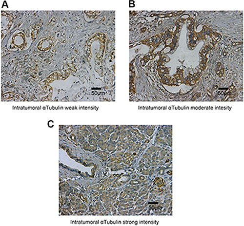 &#x03B1;Tubulin expression in tumoral tissue.