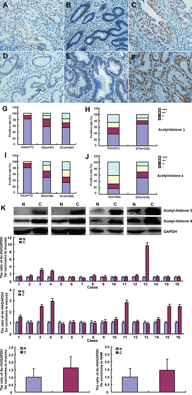 Acetyl-histone 3 and 4 expression in the pathogenesis and aggressiveness of gastric cancers.