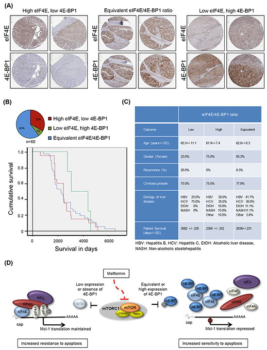 Patient HCC tumors demonstrate a variety of eIF4E and 4E-BP1 expression ratios.