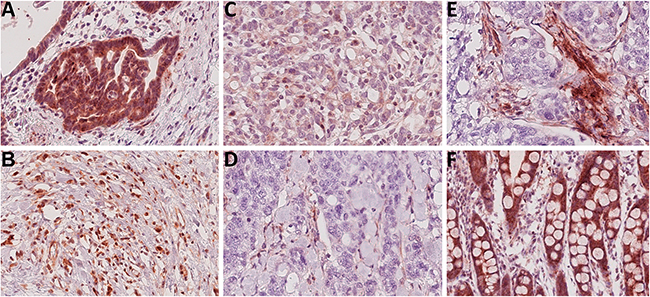 Troy expression within gastric cancer tissues.