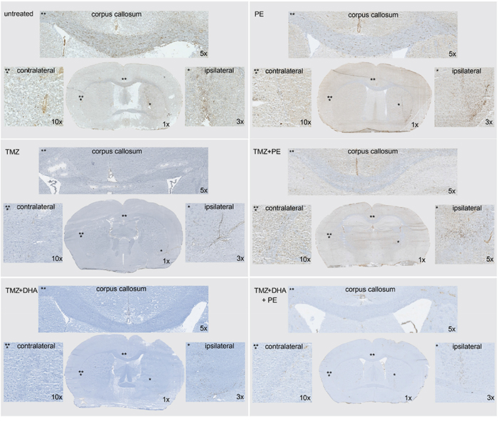 Combined treatment of DHA and/or PE with TMZ as well as TMZ-monotherapy show a massive reduction of invasiveness in orthotopically implanted T269 derived tumors in mice.