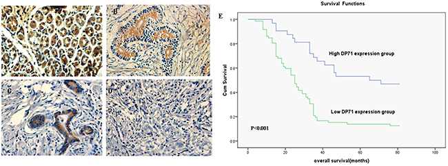 Immunohistochemistry of Dp71 expressions in gastric cancer and its prognostic implications.