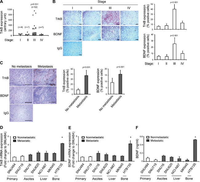 Elevated tropomyosin receptor kinase B (TrkB) and brain-derived neurotrophic factor (BDNF) expression levels in tumors from patients with advanced gastric cancer and bone metastatic gastric cancer cell lines.