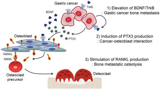 Hypothetical model of BDNF- and PTX3-induced osteolysis in bone metastatic gastric cancer.