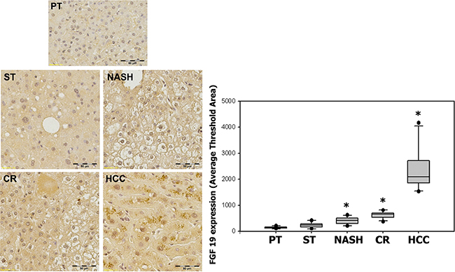 Expression of FGF19 in ST-NAHS-cirrhosis-HCC progression.