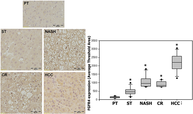 Expression of FGFR4 in ST-NAHS-cirrhosis-HCC progression.