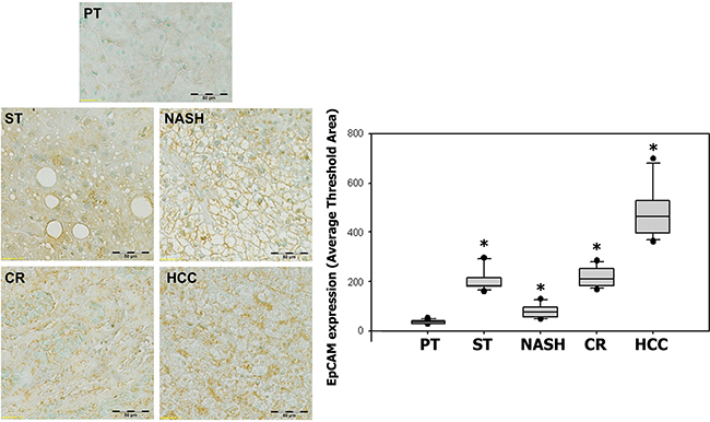 Expression of EpCAM in ST-NAHS-cirrhosis-HCC progression.