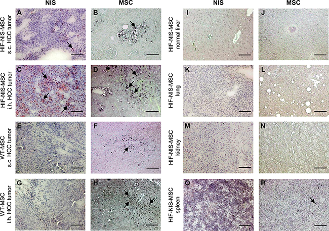 MSC recruitment and hypoxia-induced NIS expression were higher in intrahepatic compared to subcutaneous HCC tumors.