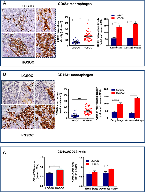 Densities of tumor associated macrophages in LGSOC and HGSOC tissue specimens.