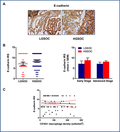 E-cadherin expression in LGSOC and HGSOC tissue specimens.