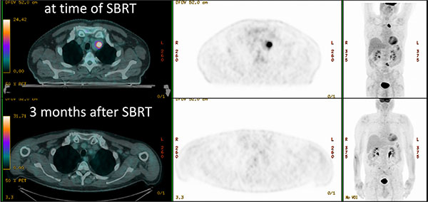 Patient treated with SBRT for a nodal metastases (dose distributions in Figure 3), with complete metabolic response 3 months after treatment.