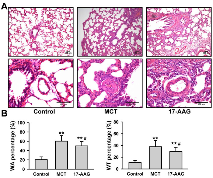 HSP90-inhibition improves pulmonary arteriole remodeling in PH.