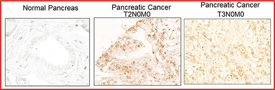 Expression of SATB2 in human pancreatic cancer tissues.