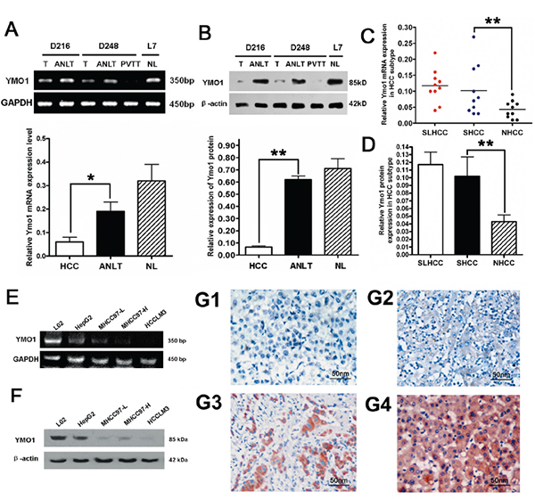 Expression level of YMO1 in HCC tissues and HCC cell lines.