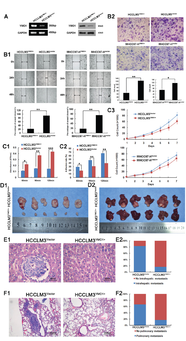 Overexpression of YMO1 suppresses HCC cell migration and invasive potential in vitro and in vivo.