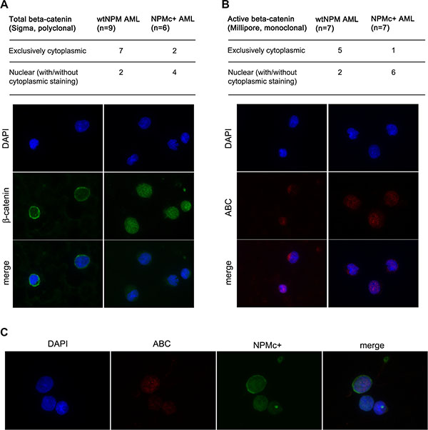 Analysis of &#x03B2;-catenin localization in AML patients.