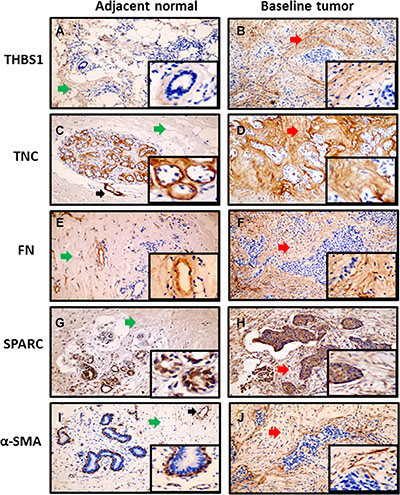 Immunoreactivity of stromal proteins in baseline tumor with matched adjacent normal tissue.