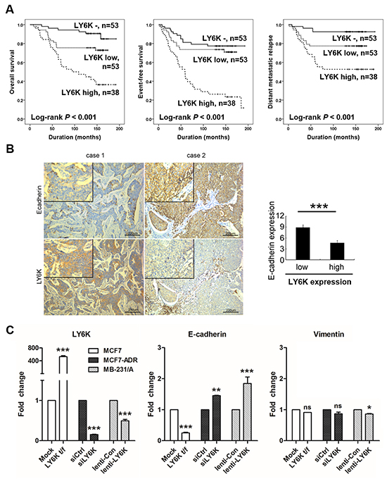 Kaplan-Meier survival analysis and LY6K induces metastasis by regulating E-cadherin.