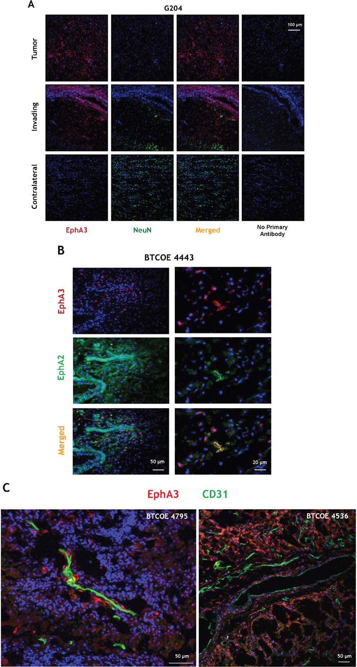 Immunofluorescent staining of EphA3 in GBM.