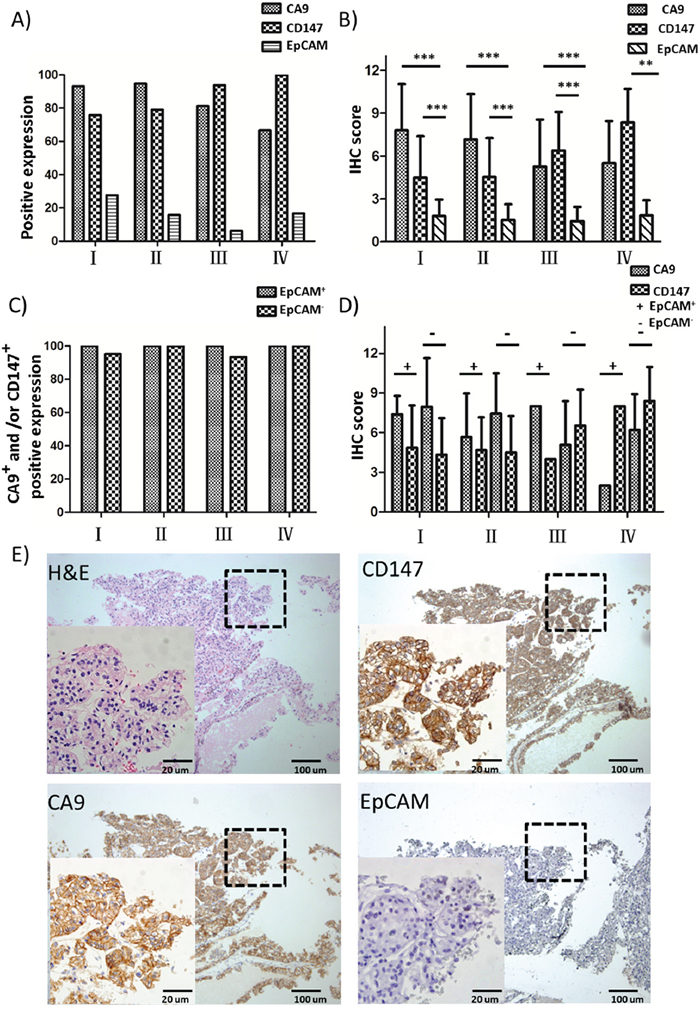 IHC analysis of EpCAM, CA9 and CD147 expression in RCC patient cohort.