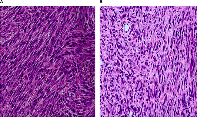 The HE staining of xenograft tumors of nude mice five weeks after subcutaneously injection of 5 &#x00D7; 106 3T3cells carrying KIF5B-RET fusion gene.