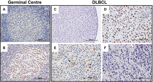 PATZ1 immunohistochemical expression in human Germinal Centre and DLBCLs.