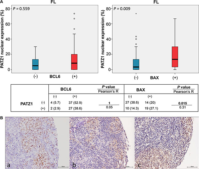 PATZ1, BCL6 and BAX expression and correlations in FLs.