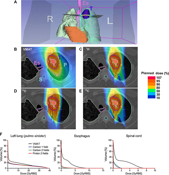 Comparative simulation of radiotherapy plans in a lung cancer patient.