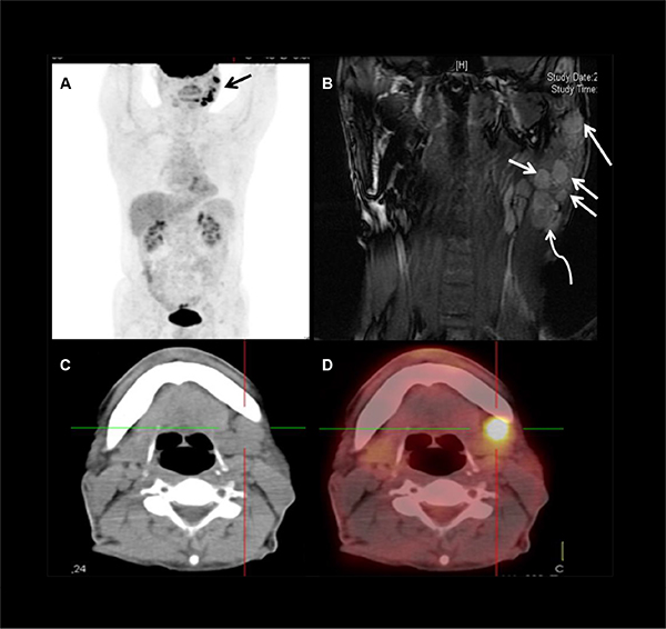 Images showing level Ib and level VIII nodes metastases in a 58 years old male patient with LELC of the left parotid gland.