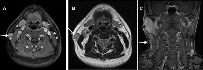 MRI showing nodal metastasis (arrow) at the surface of the right sternocleidomastoid muscle in a 51 years old male patients with LELC of the right parotid.