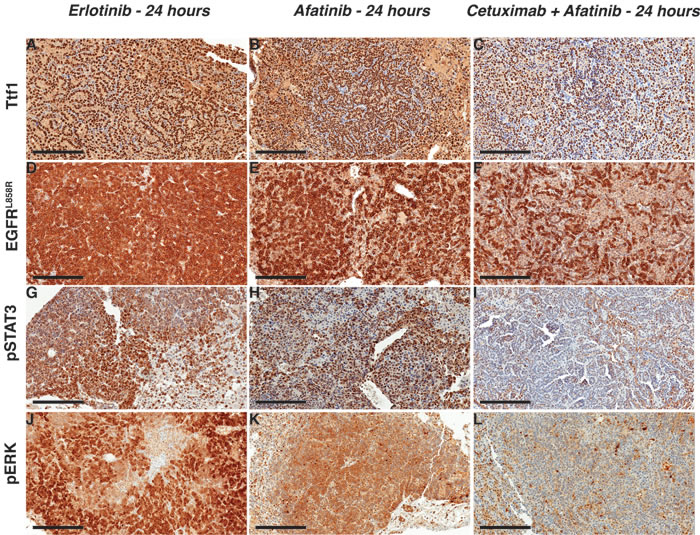 Afatinib-cetuximab combination therapy triggers rapid response by decreasing survival signals in EGFR