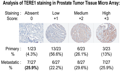 Reduced TERE1 staining in prostate carcinoma tissue micro-array.