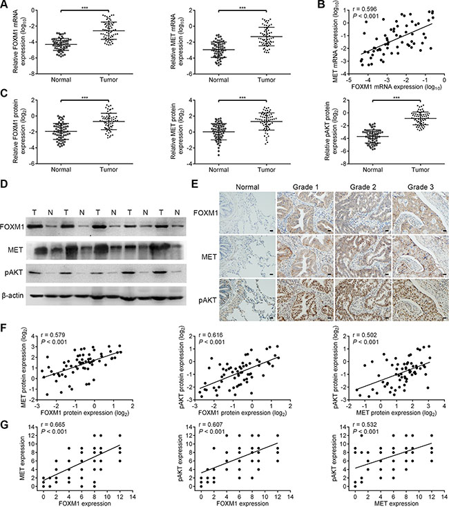 The coordinate expression of FOXM1, MET and pAKT in lung adenocarcinoma tissues.