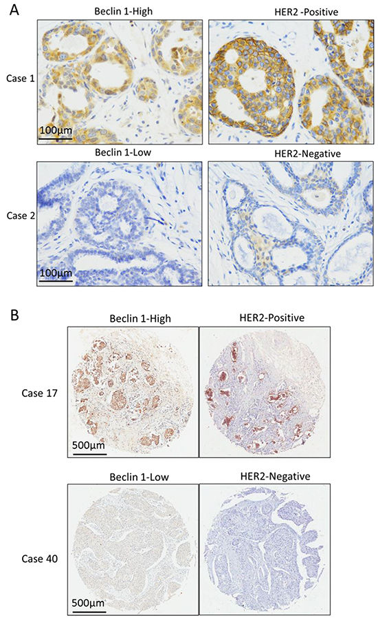 The expression relationship between Beclin 1 and HER2 in ER-positive breast cancer.