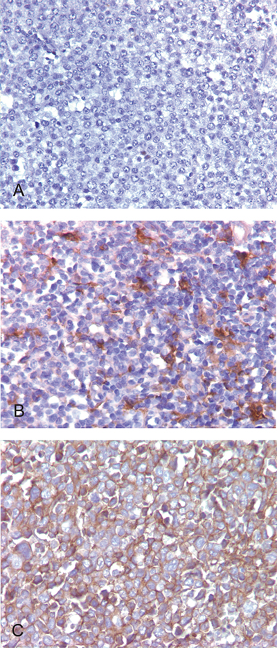 PD-L1 expression detected by immunohistochemical staining in DLBCL.