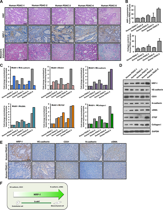 NRP-1 levels positively correlate with EndMT and fibrosis markers in human PDAC xenografts.