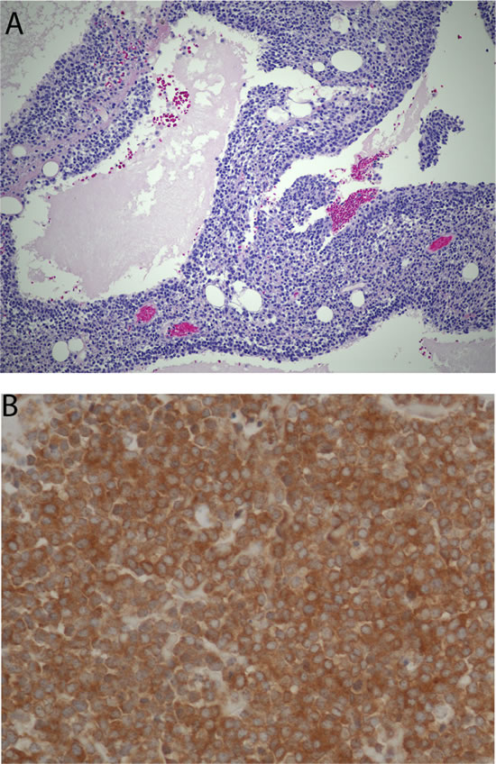 Histomorphologic appearance of a retroperitoneal tumor that could not be accurately classified by pathologists despite extensive work-up and opinions of multiple nationally-recognized experts (