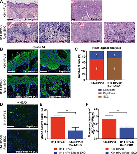 Epidermis specific deletion of Rac1 leads to SCC formation in HPV-8 mice.