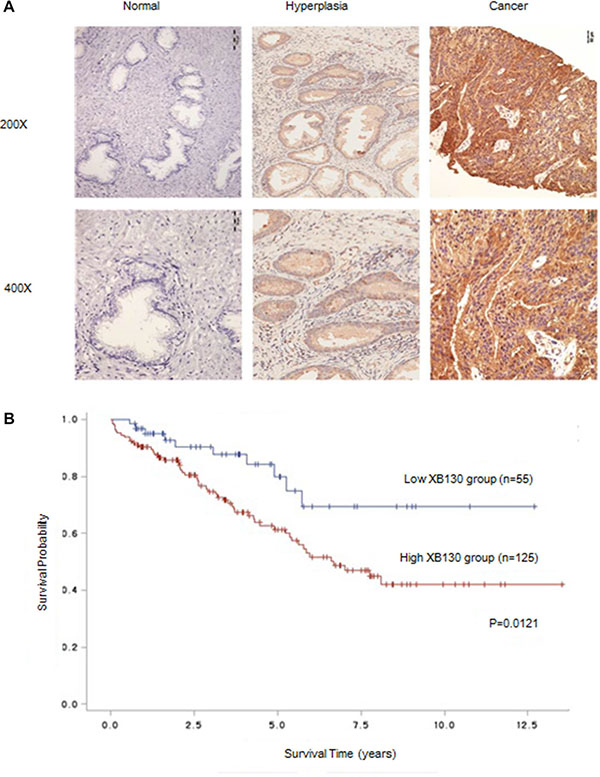 XB130 expression was correlated with prognosis of prostate cancer.