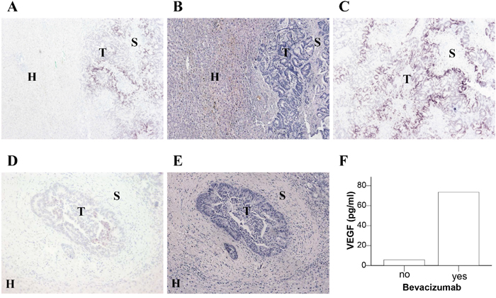 Expression of VEGF mRNA in liver sections of CRC metastases.