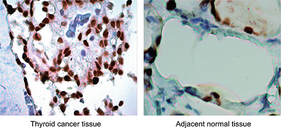 Expression of TGF-&#x03B2;1 protein in thyroid cancer (TC) tissues and adjacent normal tissues (&#x00D7; 200): TGF-&#x03B2;1 protein was mainly expressed in the cytoplasm, and presented with a diffused or granular yellowish-brown.