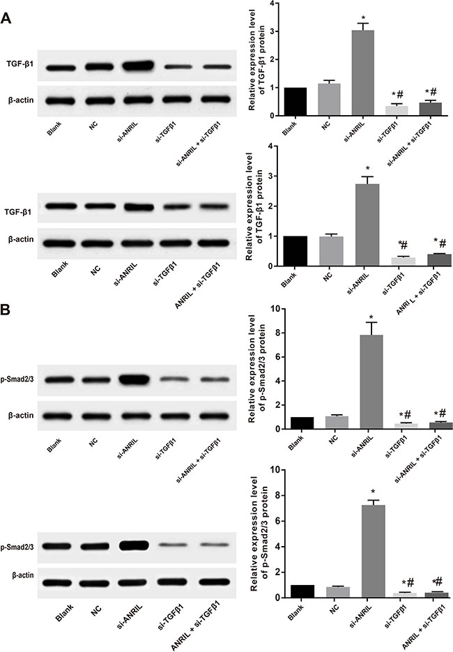 ANRIL acts through TGF&#x03B2;/Smad signaling pathway: the expressions of TGF-&#x03B2;1.