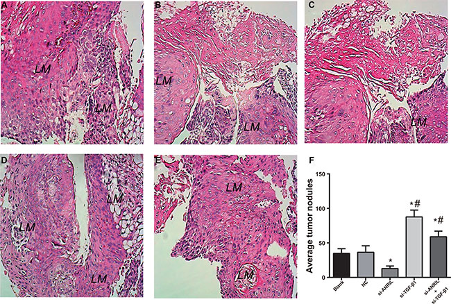 HE staining (A&#x2013;E) and statistical analysis (F) results of lung metastatic nodules in the nude mice after tail vein injection of TPC-1 cells (&#x00D7; 200).