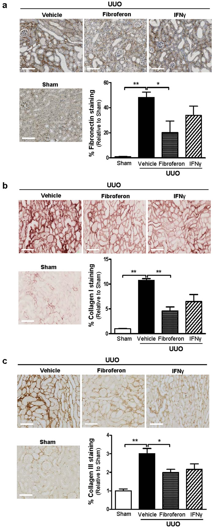 Fibroferon reduces extracellular matrix deposition (fibronectin, collagen I, and collagen III) in mouse UUO kidneys.