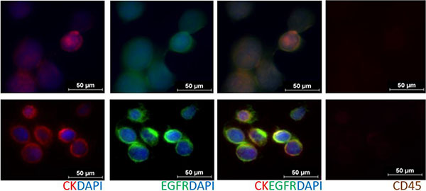 Immunofluorescent staining of CTCs from RosetteSep&#x2122; enrichred head and neck cancer patient blood samples (Row 1: Pt #10, Row 2: Pt #17), stained with an antibody cocktail (Cellsearch&#x00AE;: anti-Cytokeratin 8/18/19, DAPI, anti-CD45) and anti-EGFR.